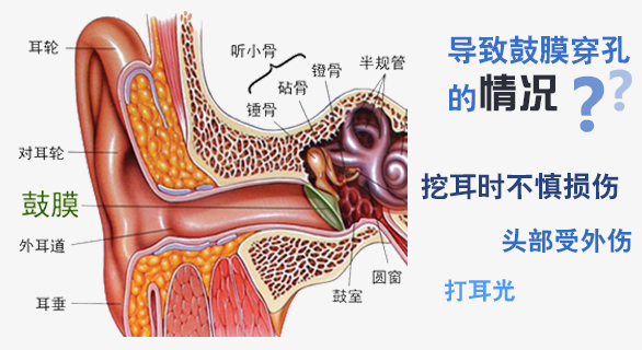 导致鼓膜穿孔的原因