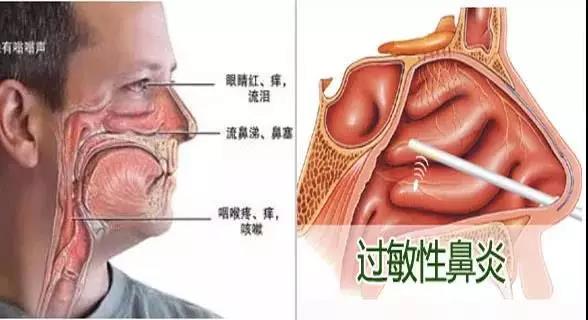 过敏性鼻炎剖析图