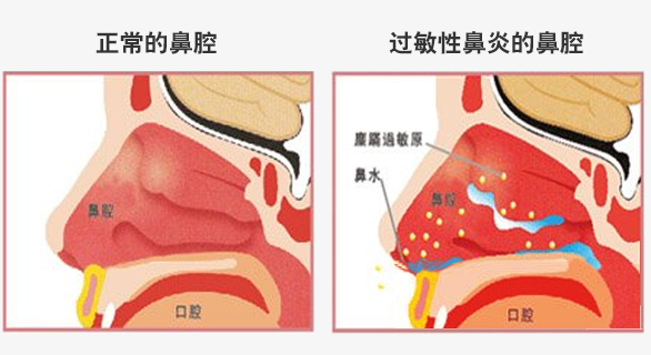 正常鼻腔与过敏性鼻腔解析对比图