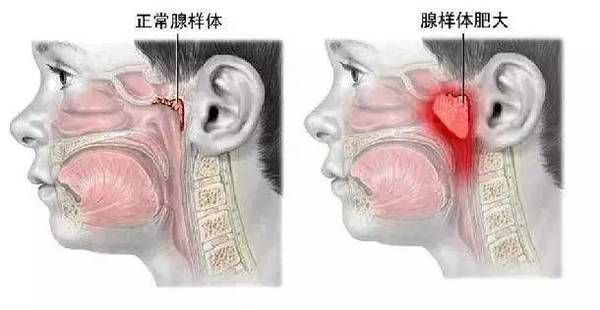 腺样体对比剖析图