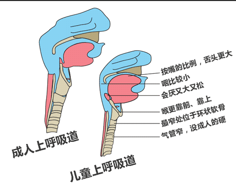 成人、小孩儿急性会厌炎对比解析图