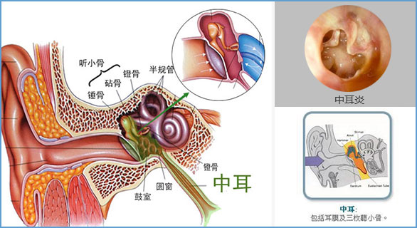 耳部结构剖析图——中耳炎